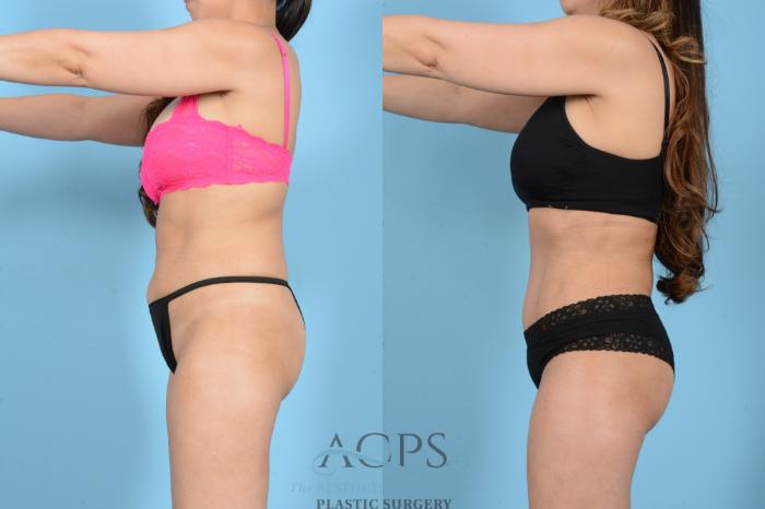 Before & After Tummy Tuck Case 1544 Left Side View in Houston, TX