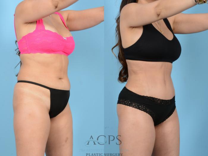 Before & After Tummy Tuck Case 1544 Right Oblique View in Houston, TX