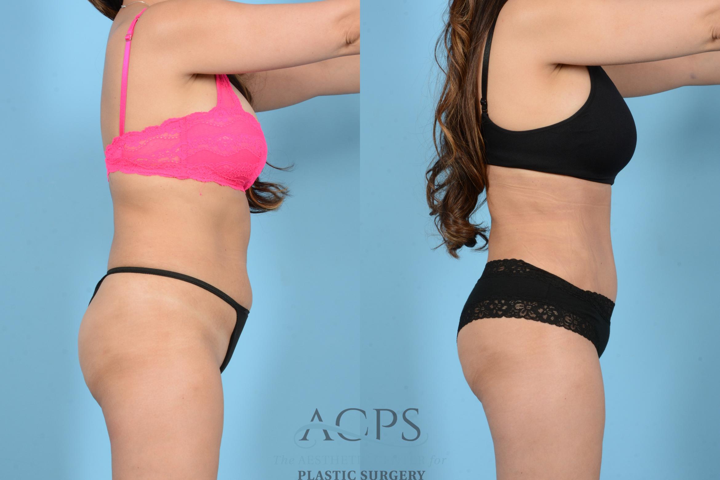 Before & After Tummy Tuck Case 1544 Right Side View in Houston, TX