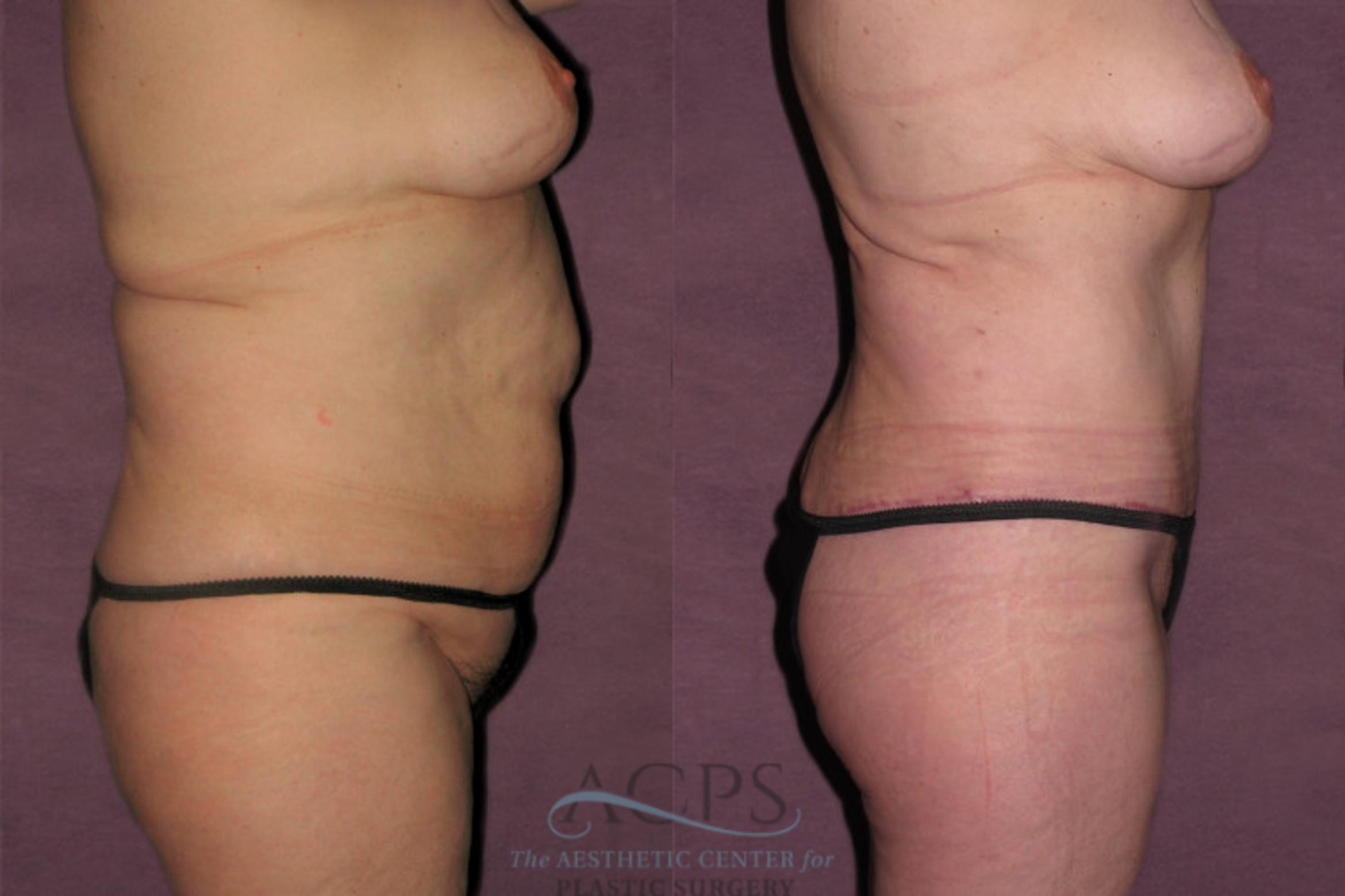 Before & After Tummy Tuck Case 155 Oblique Right View: View in Houston, TX