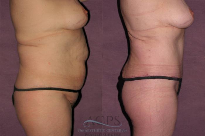 Before & After Tummy Tuck Case 155 Oblique Right View: View in Houston, TX