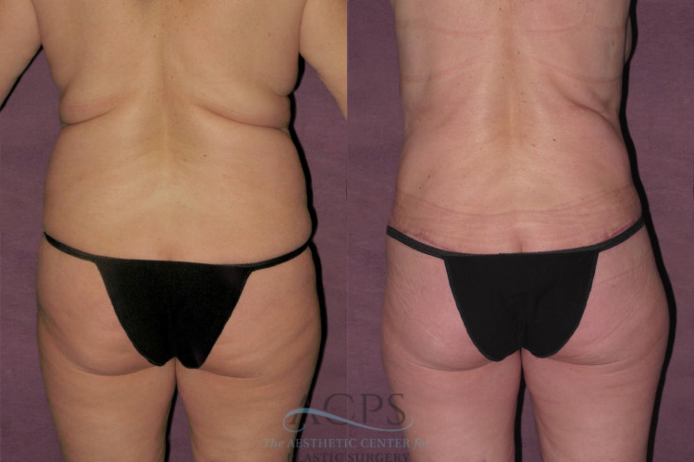Before & After Tummy Tuck Case 155 Rear View: View in Houston, TX