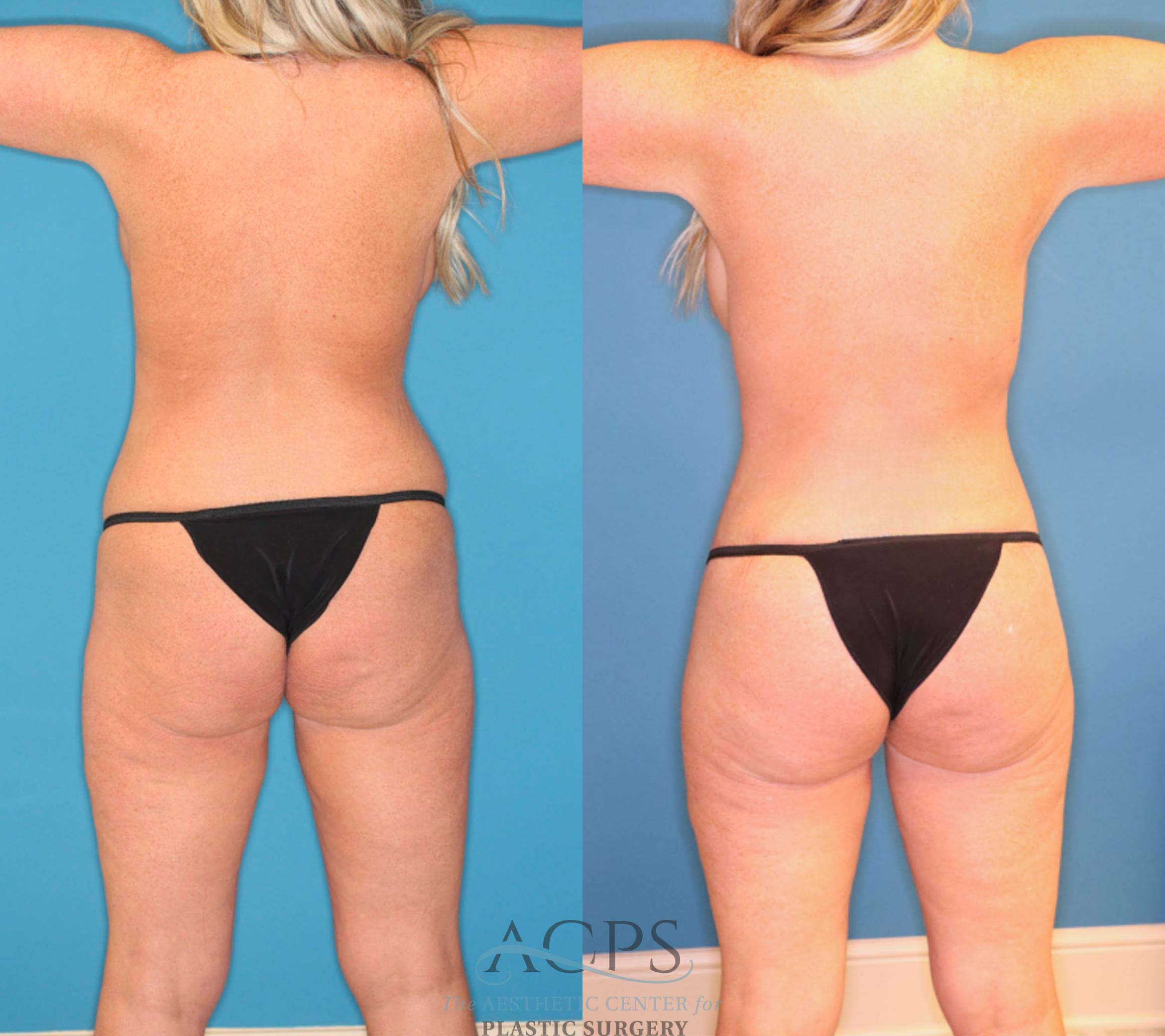 Before & After Tummy Tuck Case 1551 Back View in Houston, TX