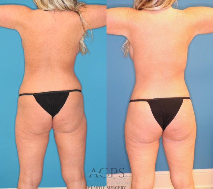 Before & After Tummy Tuck Case 1551 Back View in Houston, TX