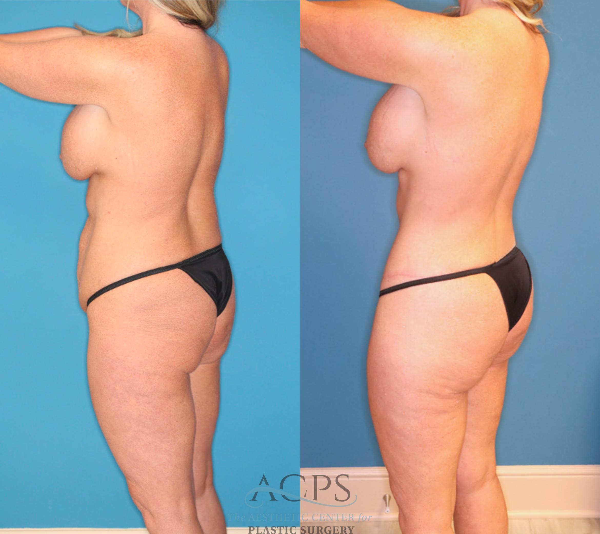 Before & After Tummy Tuck Case 1551 Left Rear View in Houston, TX
