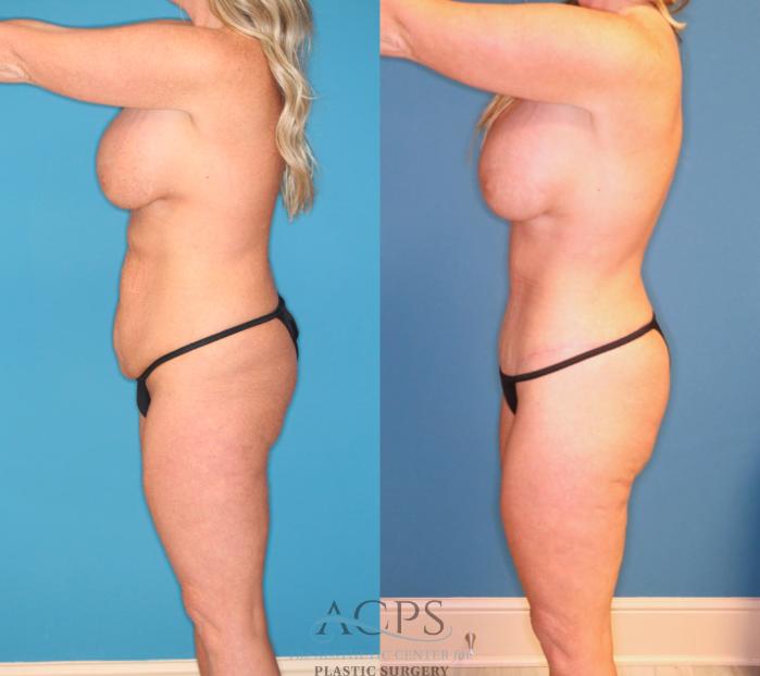 Before & After Tummy Tuck Case 1551 Left Side View in Houston, TX