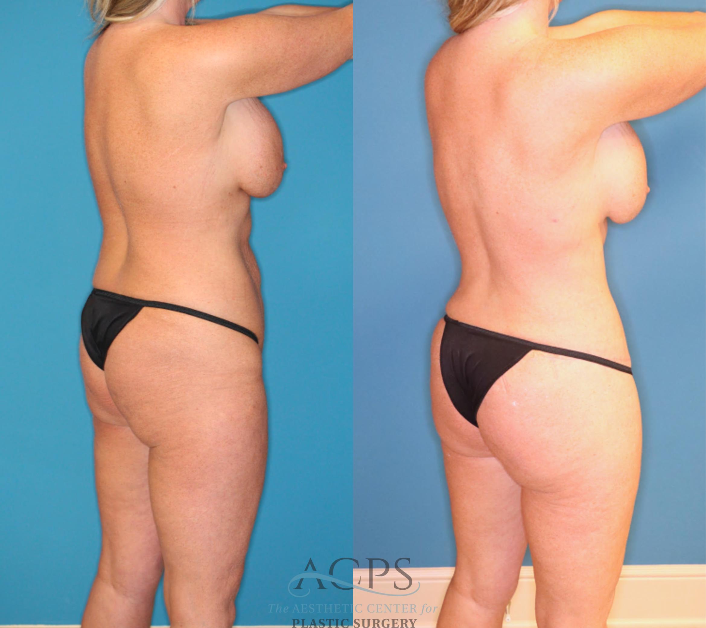 Before & After Tummy Tuck Case 1551 Right Rear View in Houston, TX