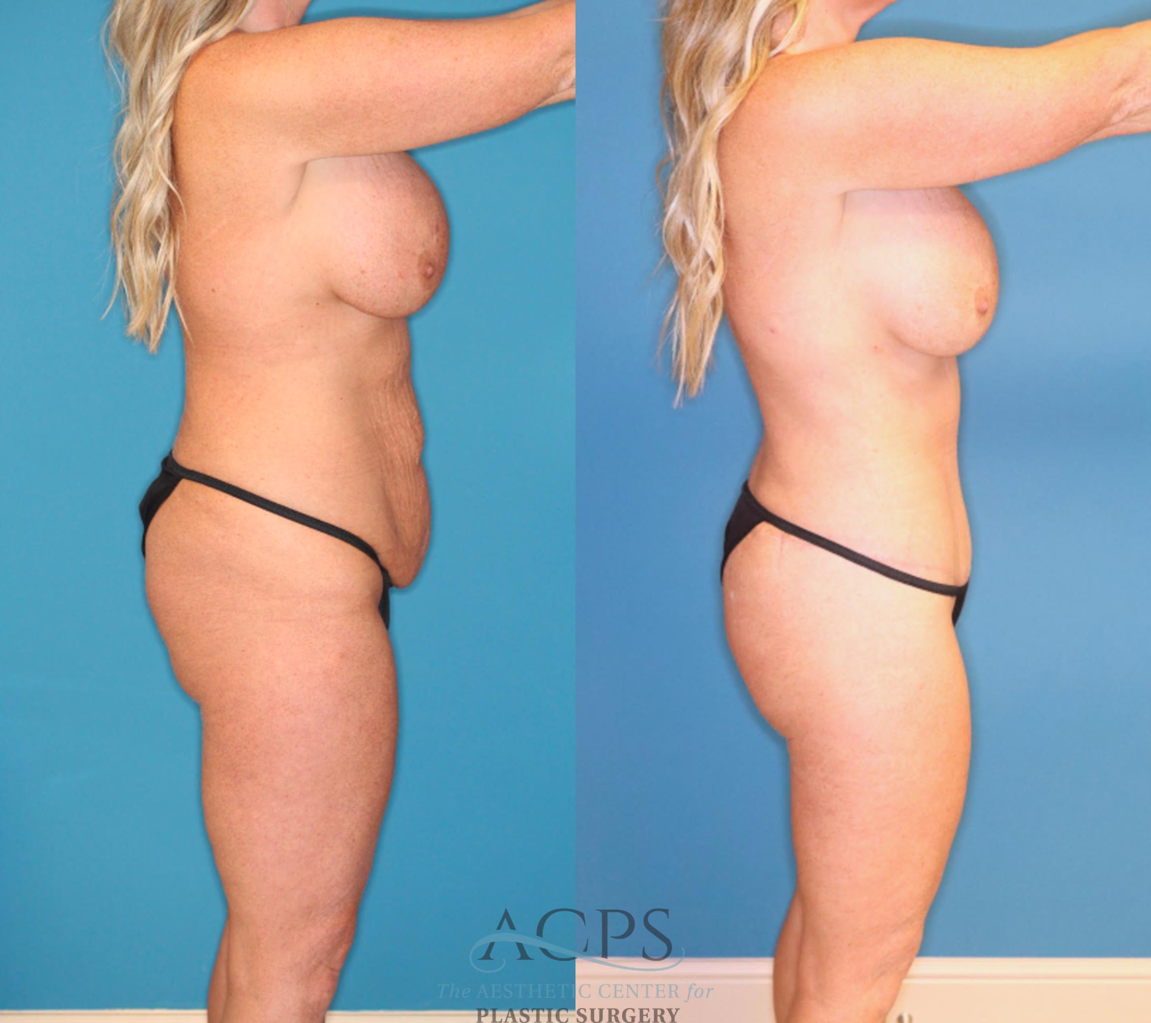 Before & After Tummy Tuck Case 1551 Right Side View in Houston, TX
