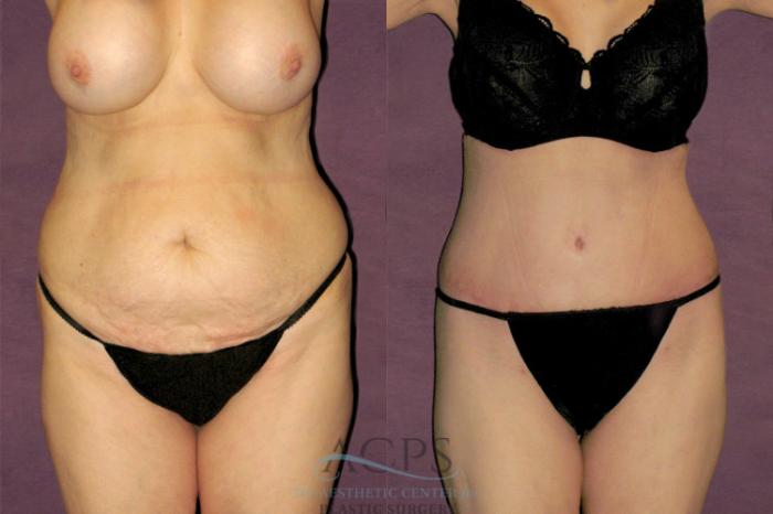 Before & After Tummy Tuck Case 156 Front View: View in Houston, TX