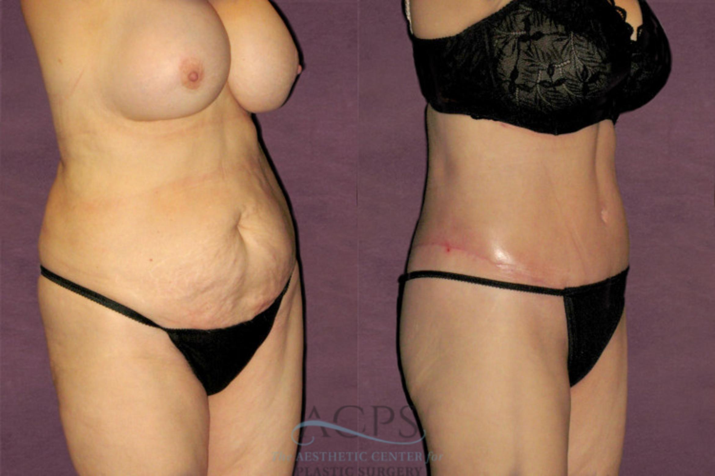 Before & After Tummy Tuck Case 156 Oblique Right View: View in Houston, TX