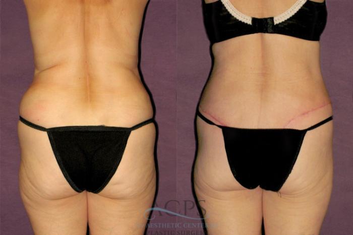 Before & After Tummy Tuck Case 156 Rear View: View in Houston, TX