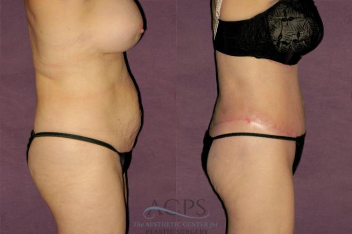 Before & After Tummy Tuck Case 156 Side Right View: View in Houston, TX