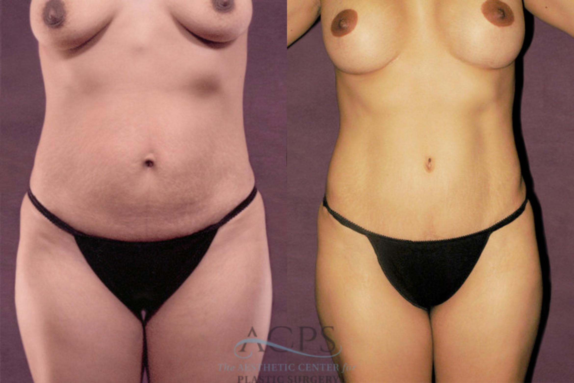 Before & After Tummy Tuck Case 157 Front View: View in Houston, TX