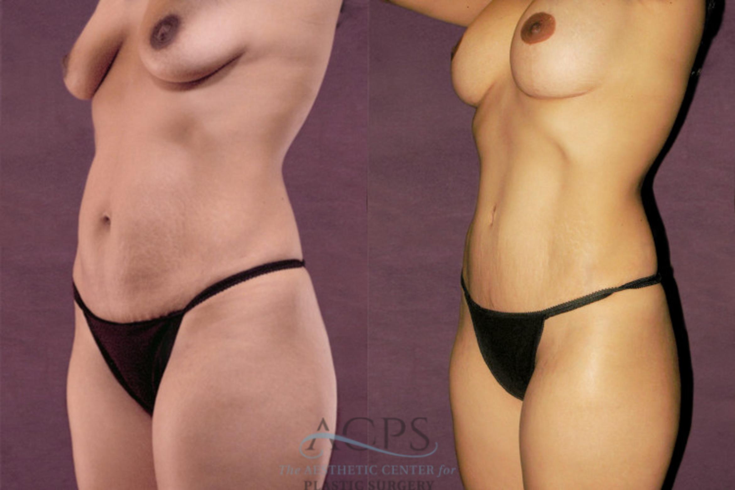 Before & After Tummy Tuck Case 157 Oblique Left View: View in Houston, TX