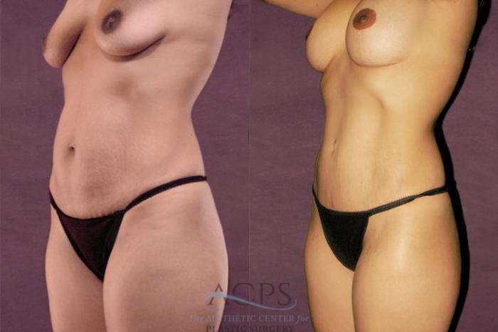 Before & After Tummy Tuck Case 157 Oblique Left View: View in Houston, TX