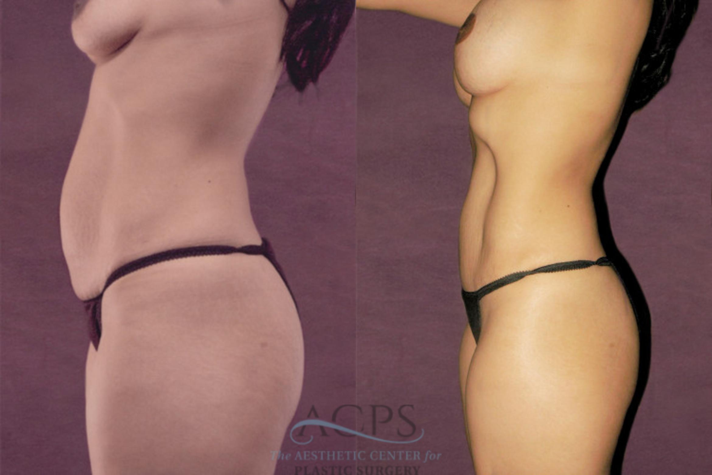 Before & After Tummy Tuck Case 157 Side View: View in Houston, TX
