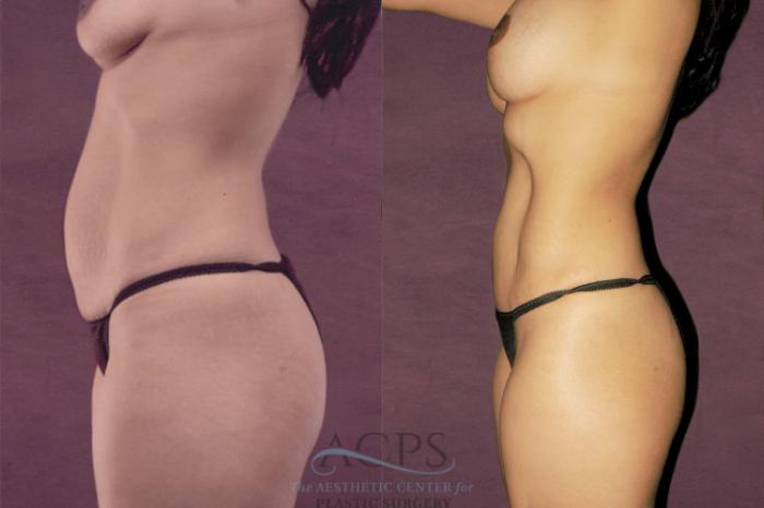 Before & After Tummy Tuck Case 157 Side View: View in Houston, TX