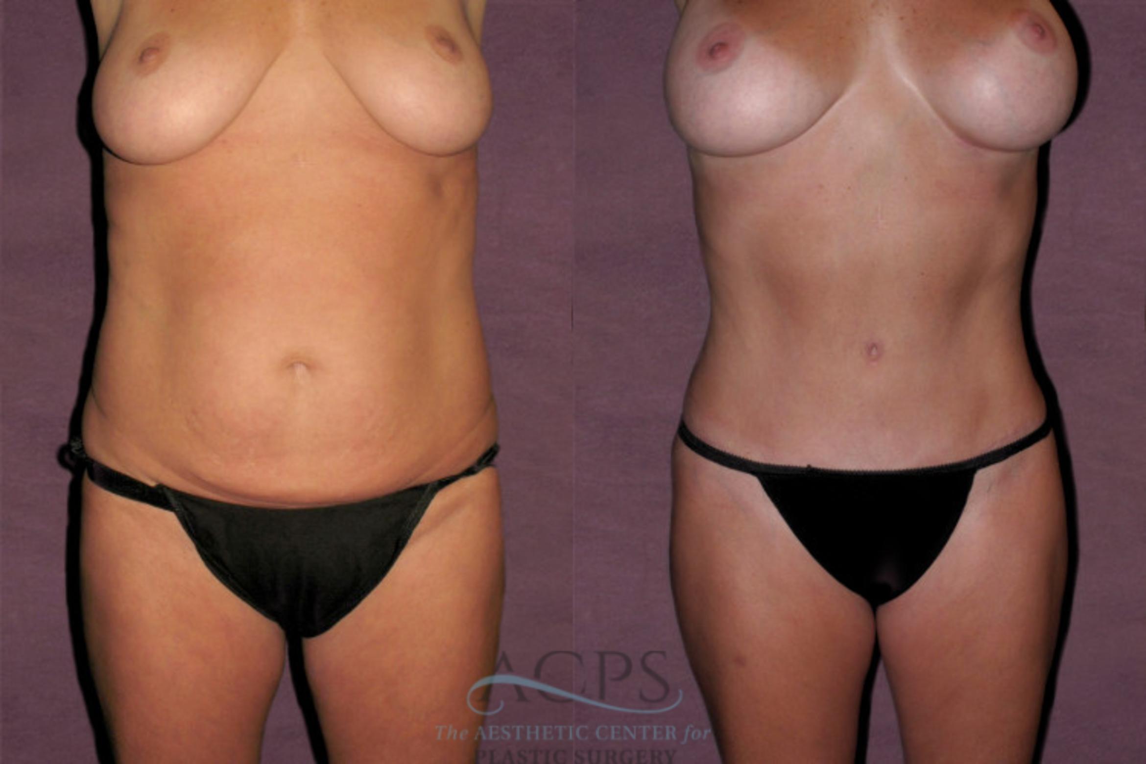 Before & After Mommy Makeover Case 158 Front View: View in Houston, TX