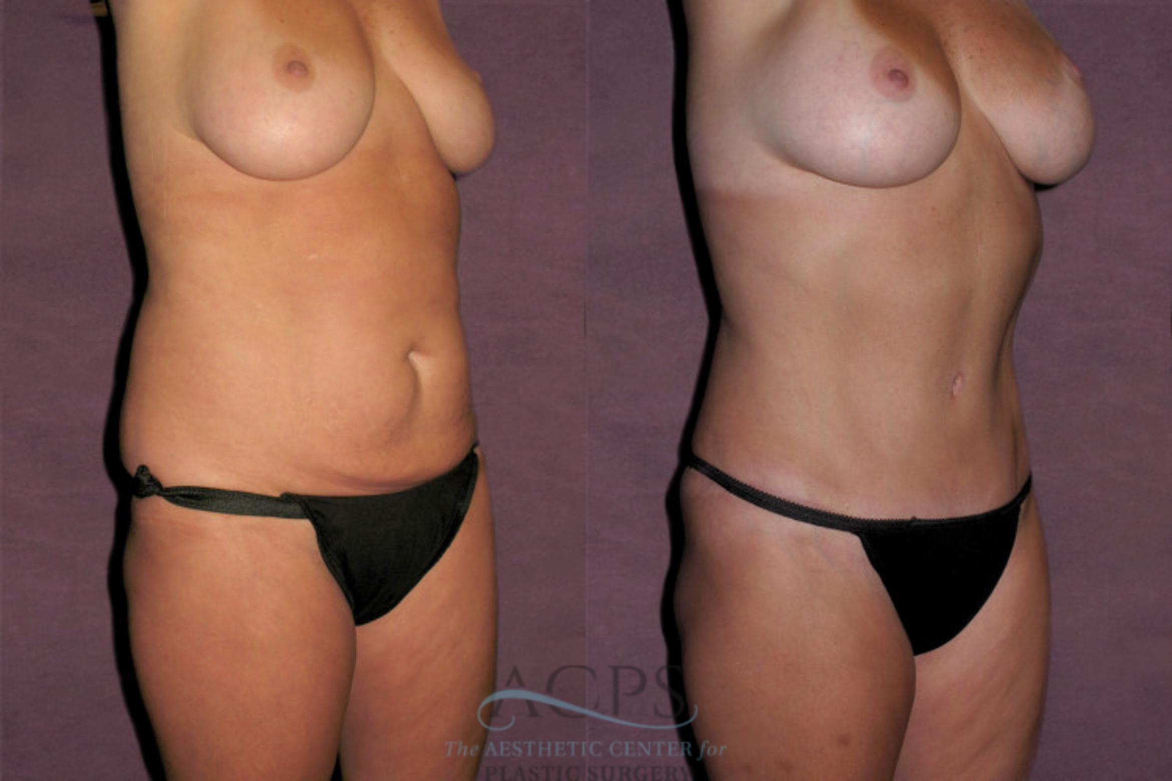 Before & After Mommy Makeover Case 158 Oblique Right View: View in Houston, TX