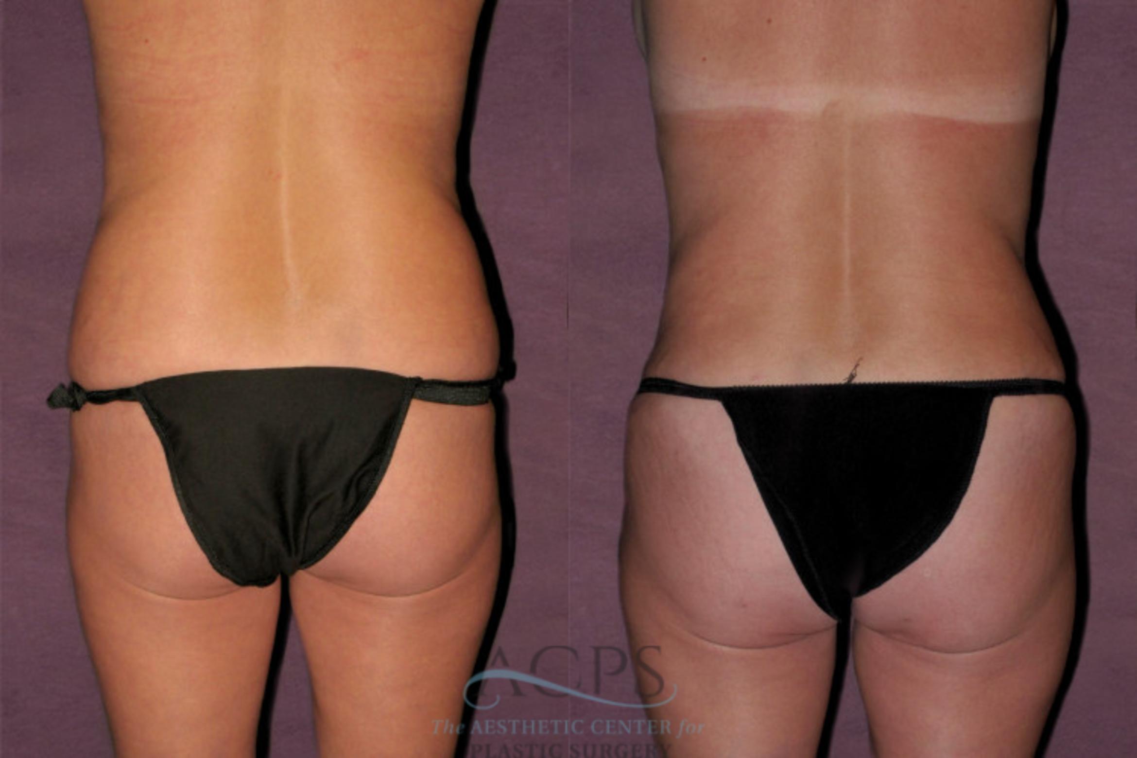 Before & After Mommy Makeover Case 158 Rear View: View in Houston, TX