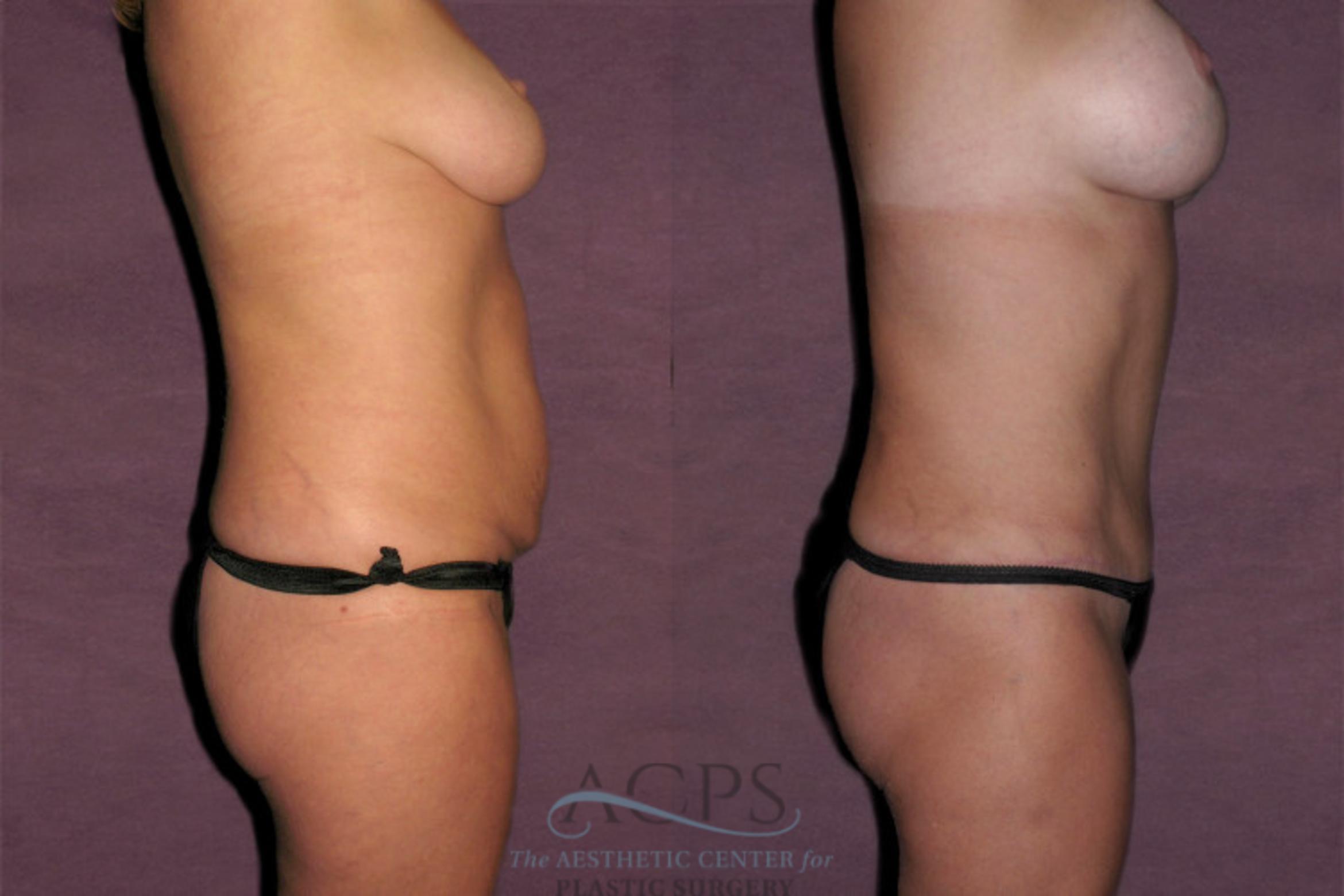 Before & After Mommy Makeover Case 158 Side View: View in Houston, TX