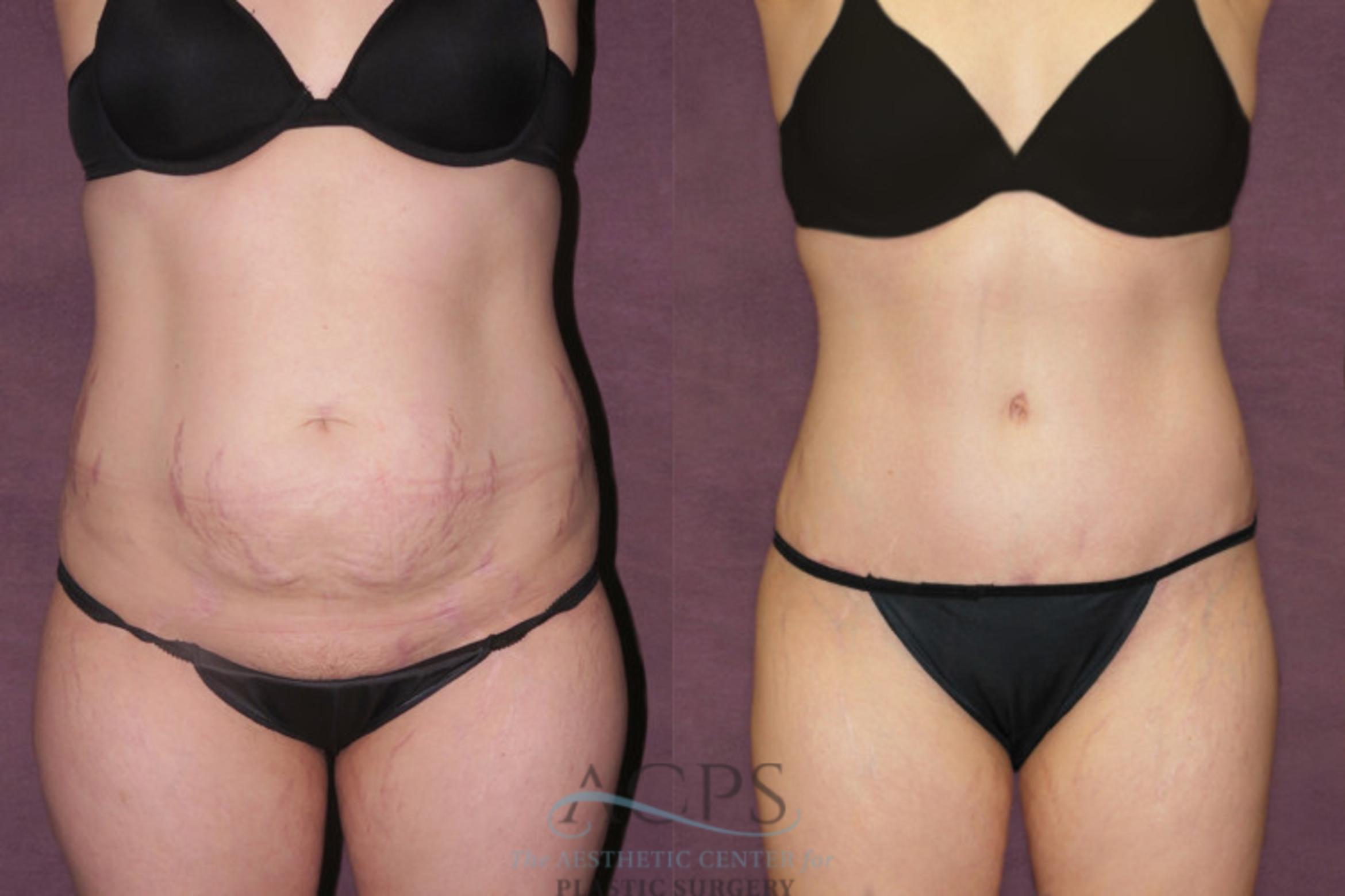 Before & After Tummy Tuck Case 159 Front View: View in Houston, TX
