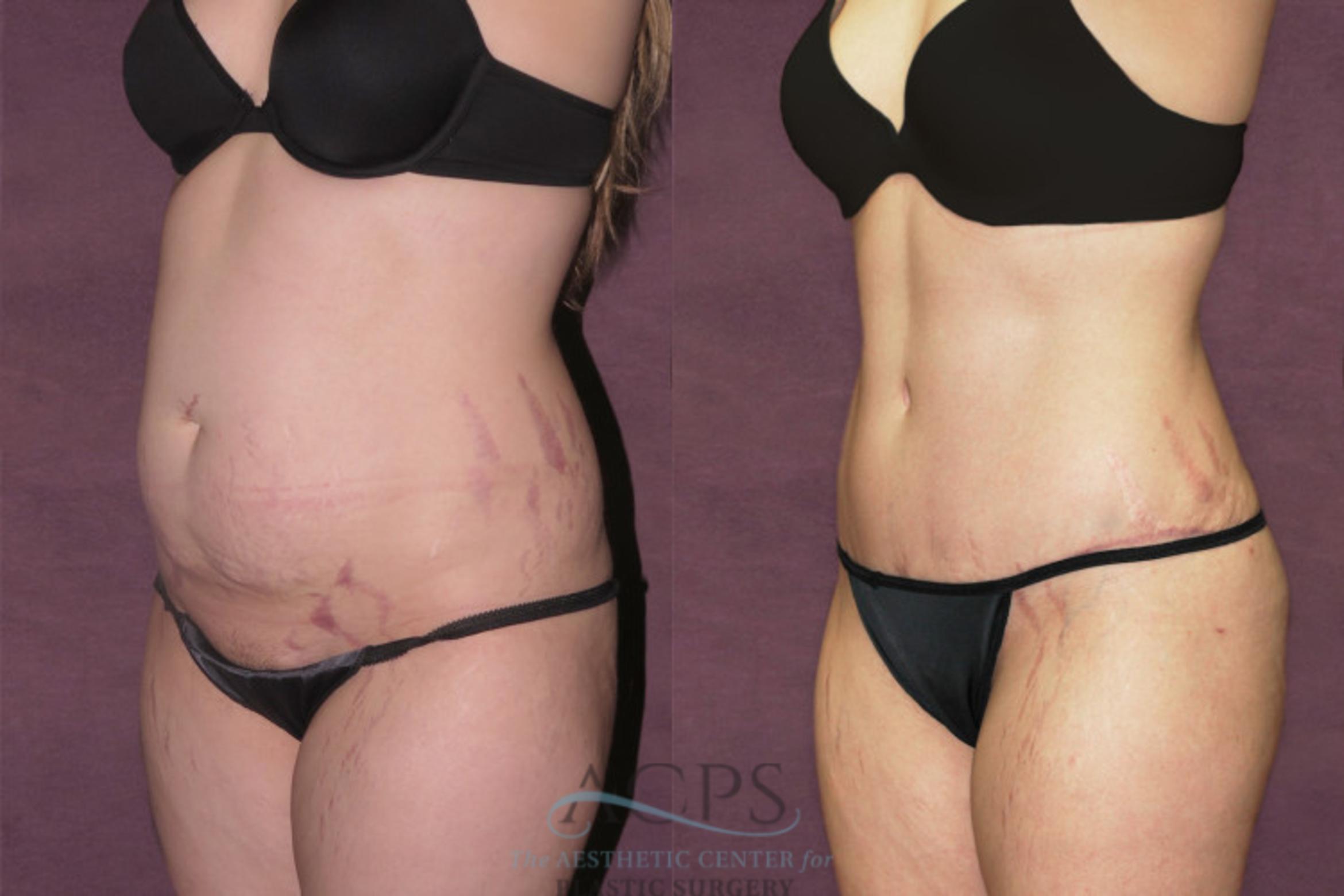 Before & After Tummy Tuck Case 159 Oblique Left View: View in Houston, TX