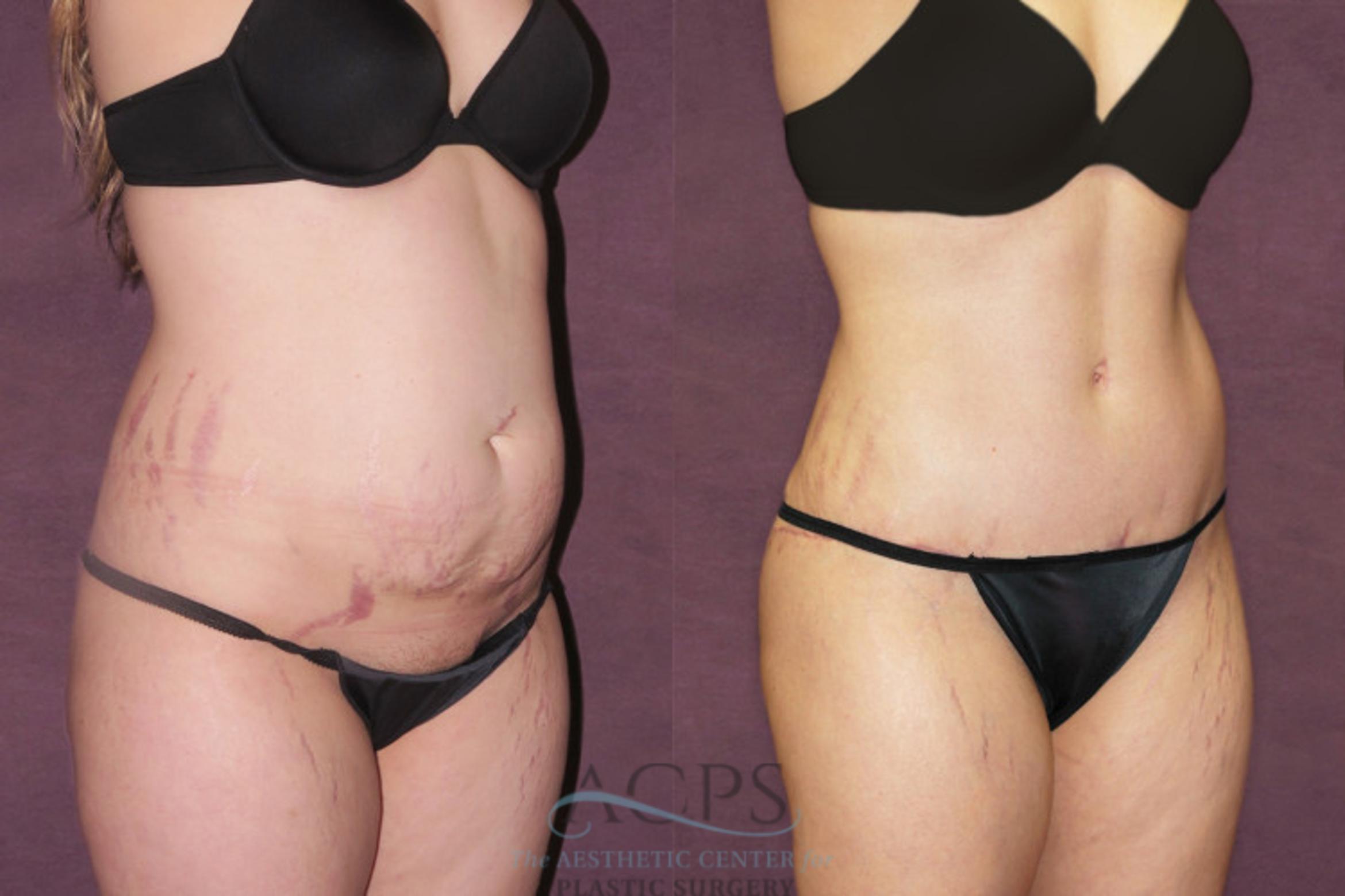 Before & After Tummy Tuck Case 159 Oblique Right View: View in Houston, TX