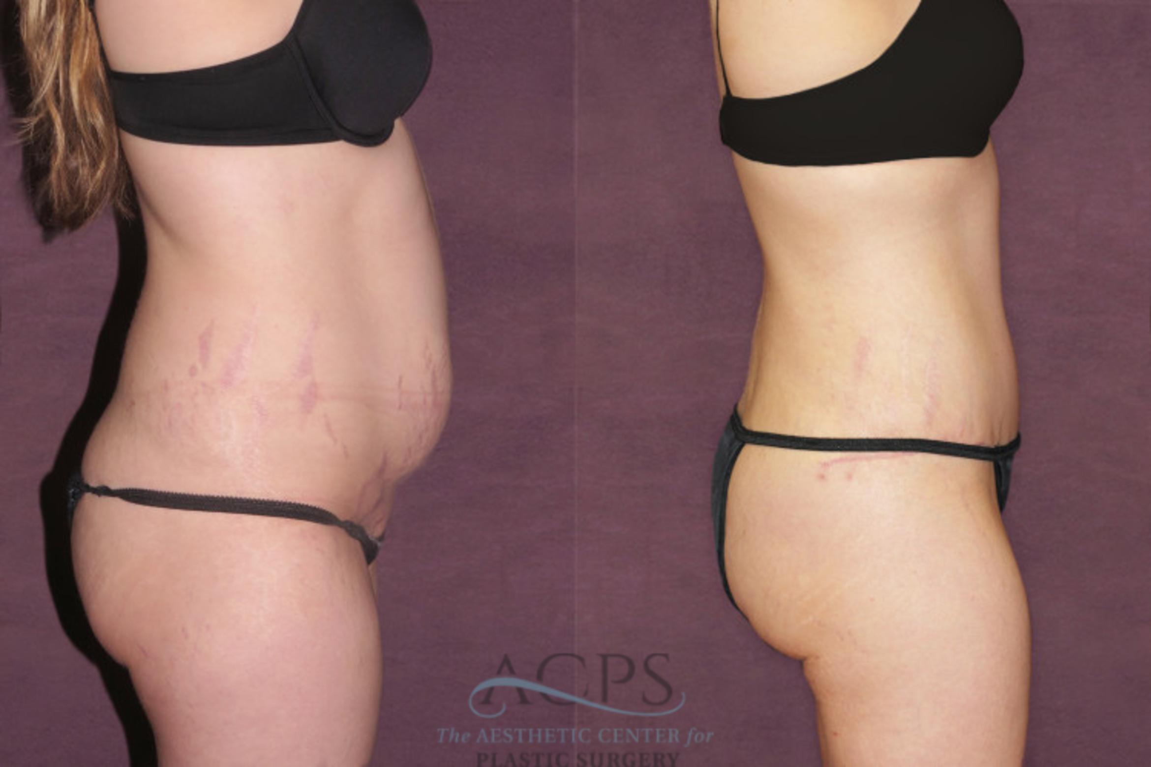 Before & After Tummy Tuck Case 159 Side Right View: View in Houston, TX
