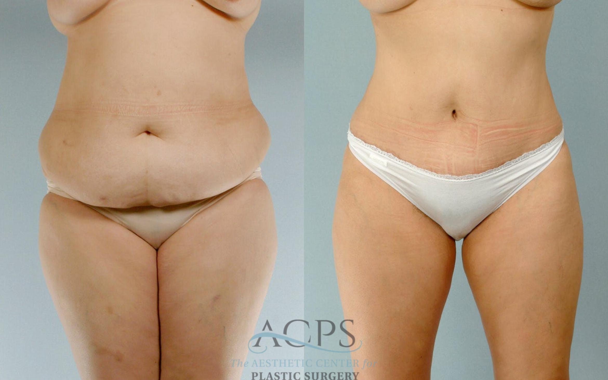 Before & After Tummy Tuck Case 16 Front View: View in Houston, TX