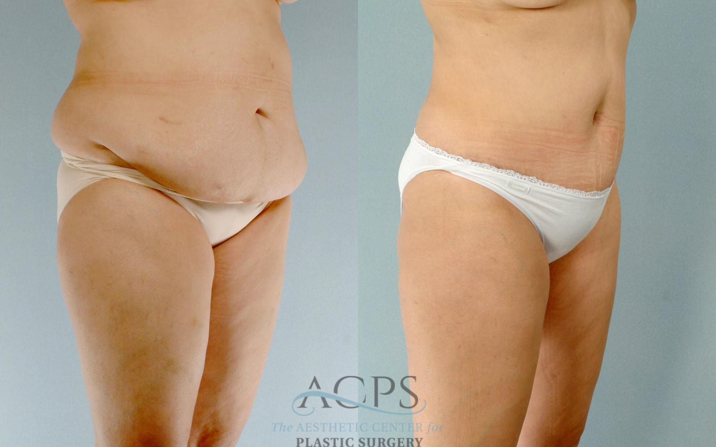 Before & After Tummy Tuck Case 16 Oblique View: View in Houston, TX