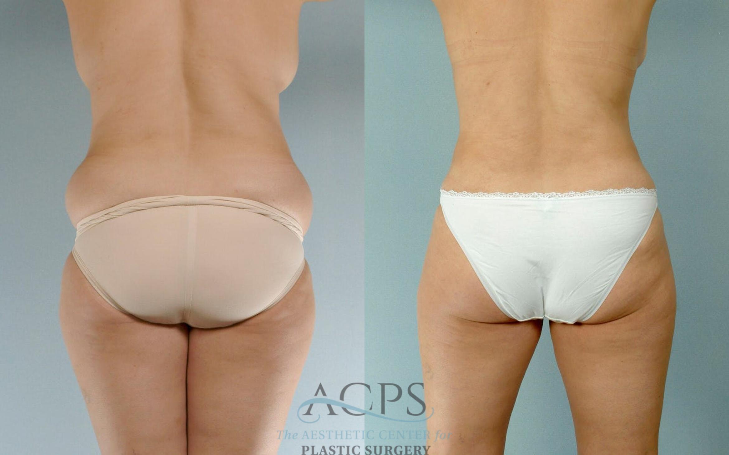 Before & After Tummy Tuck Case 16 Rear View: View in Houston, TX