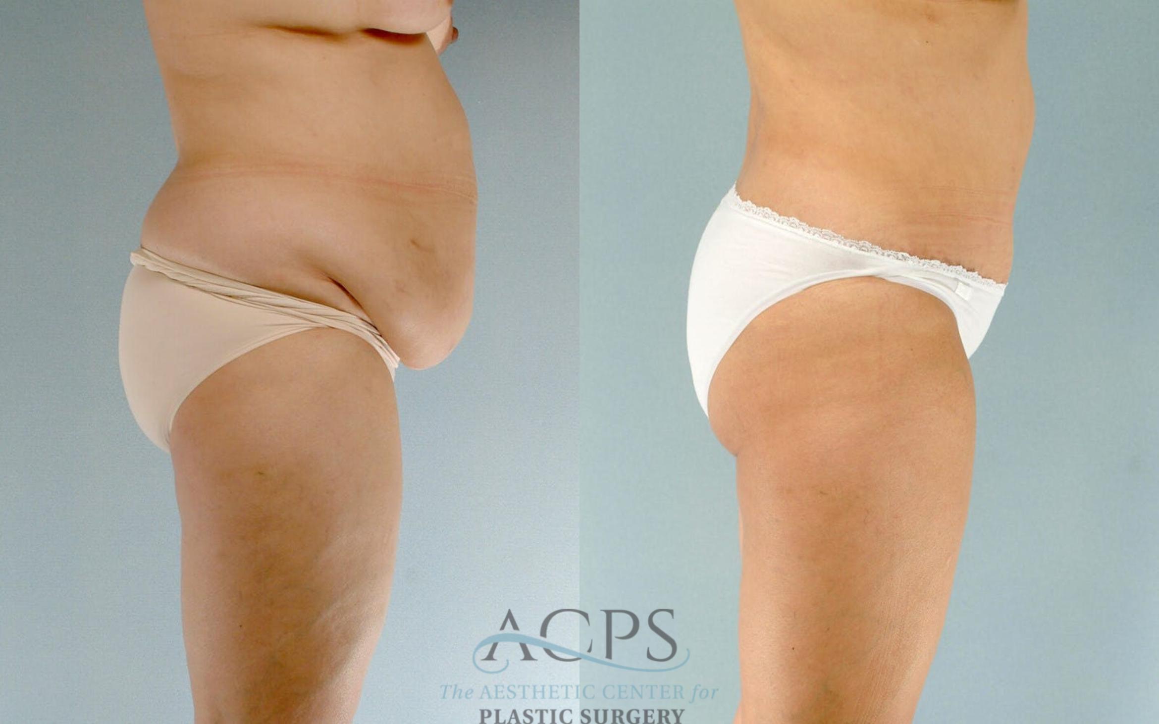 Before & After Tummy Tuck Case 16 Side View: View in Houston, TX