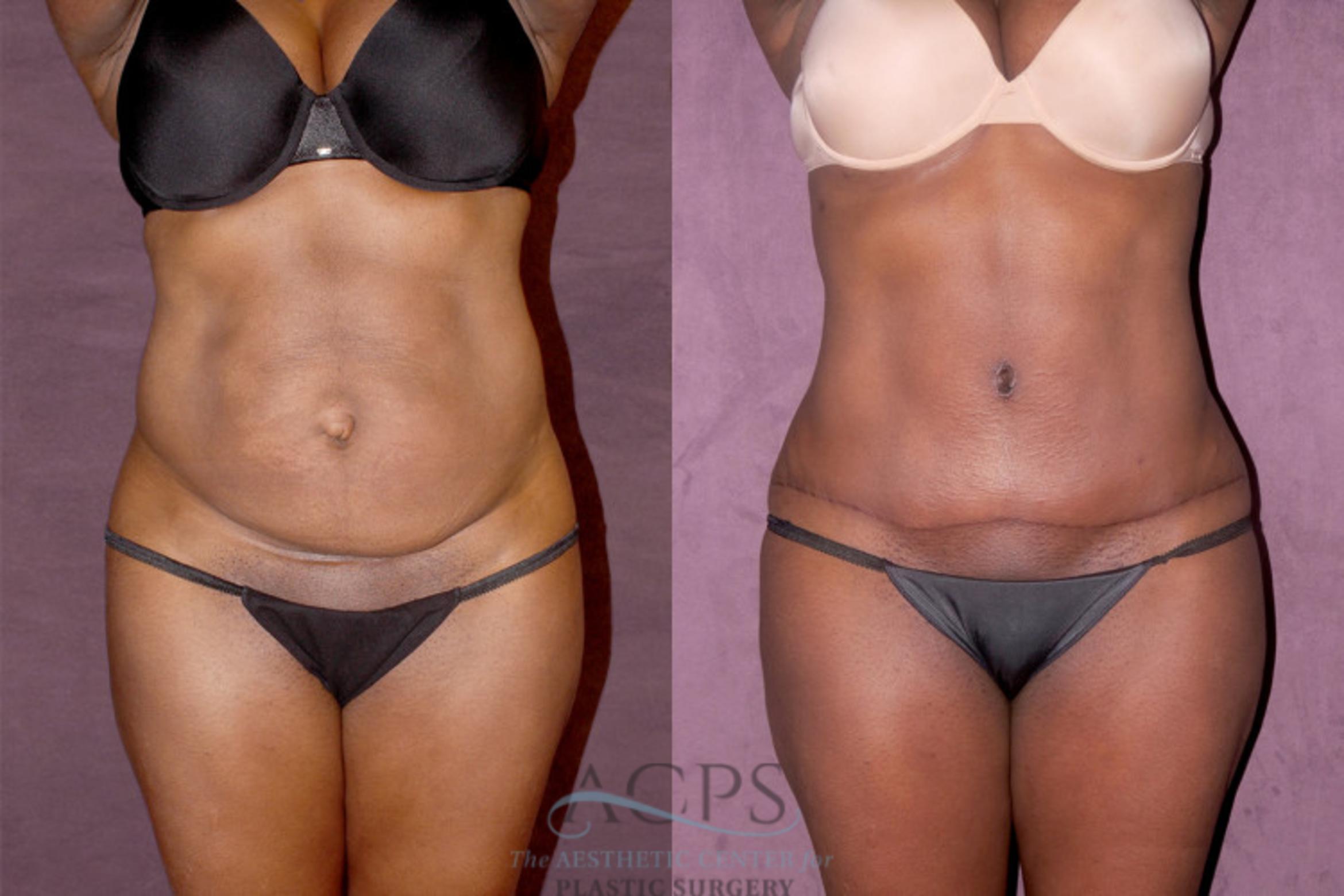 Before & After Tummy Tuck Case 160 Front View: View in Houston, TX
