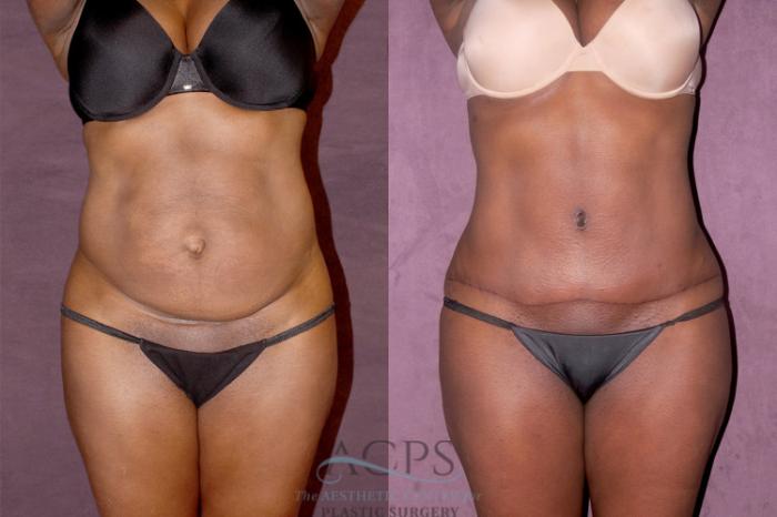 Before & After Tummy Tuck Case 160 Front View: View in Houston, TX