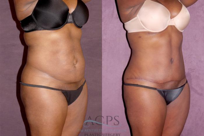 Before & After Tummy Tuck Case 160 Oblique Right View: View in Houston, TX