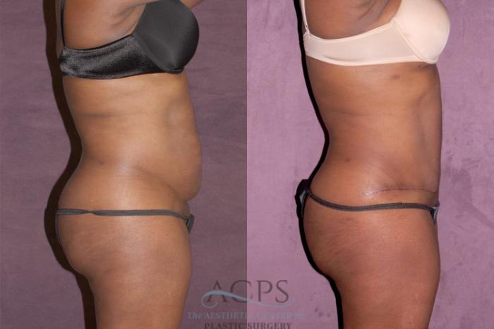 Before & After Tummy Tuck Case 160 Side Right View: View in Houston, TX