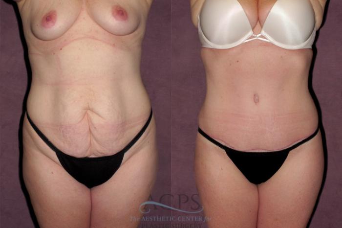 Before & After Tummy Tuck Case 161 Front View: View in Houston, TX