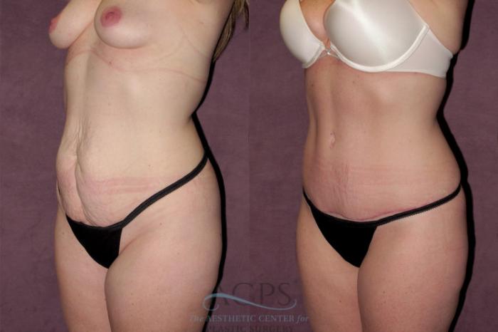 Before & After Tummy Tuck Case 161 Oblique Right View: View in Houston, TX