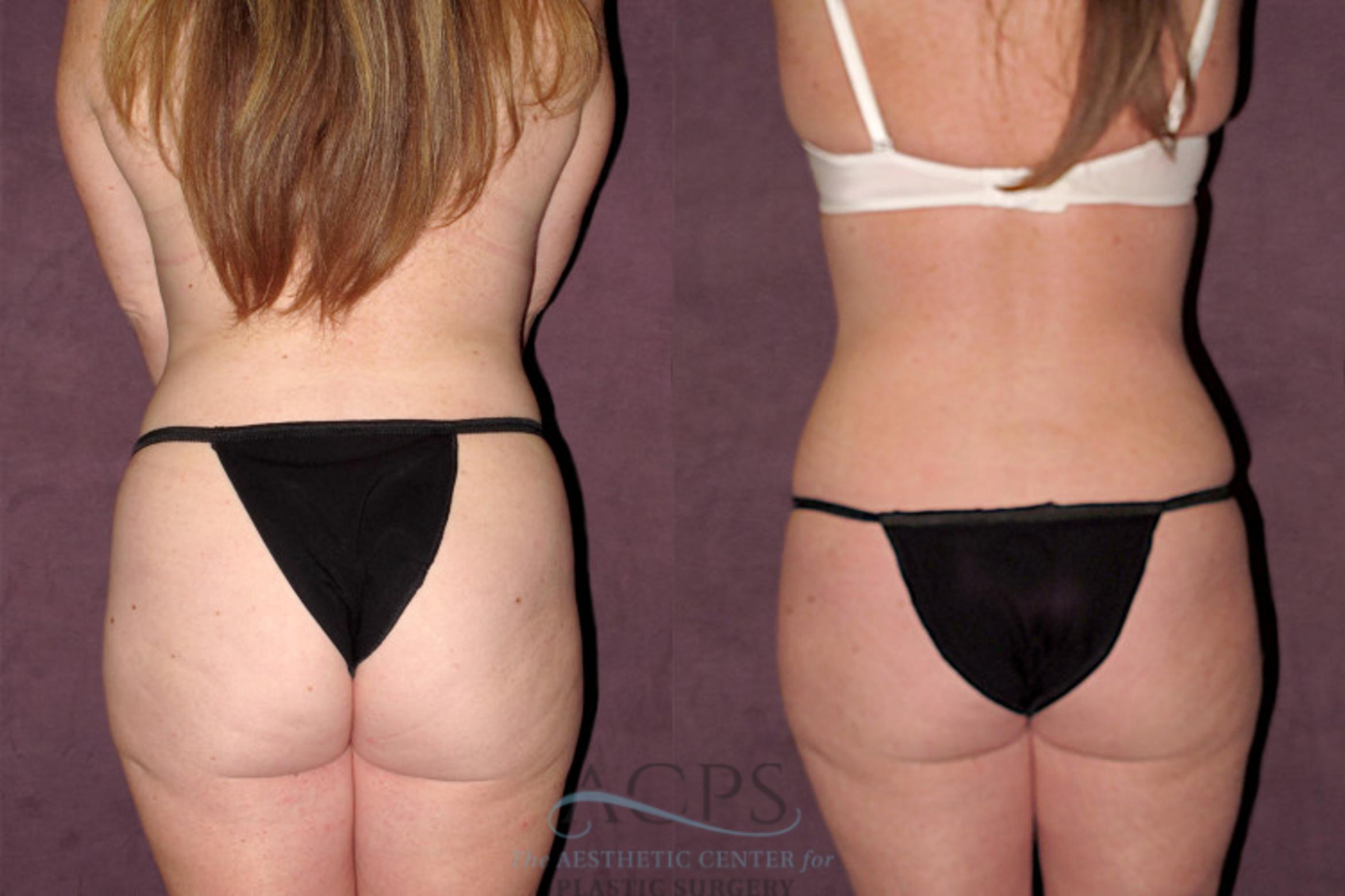 Before & After Tummy Tuck Case 161 Rear View: View in Houston, TX