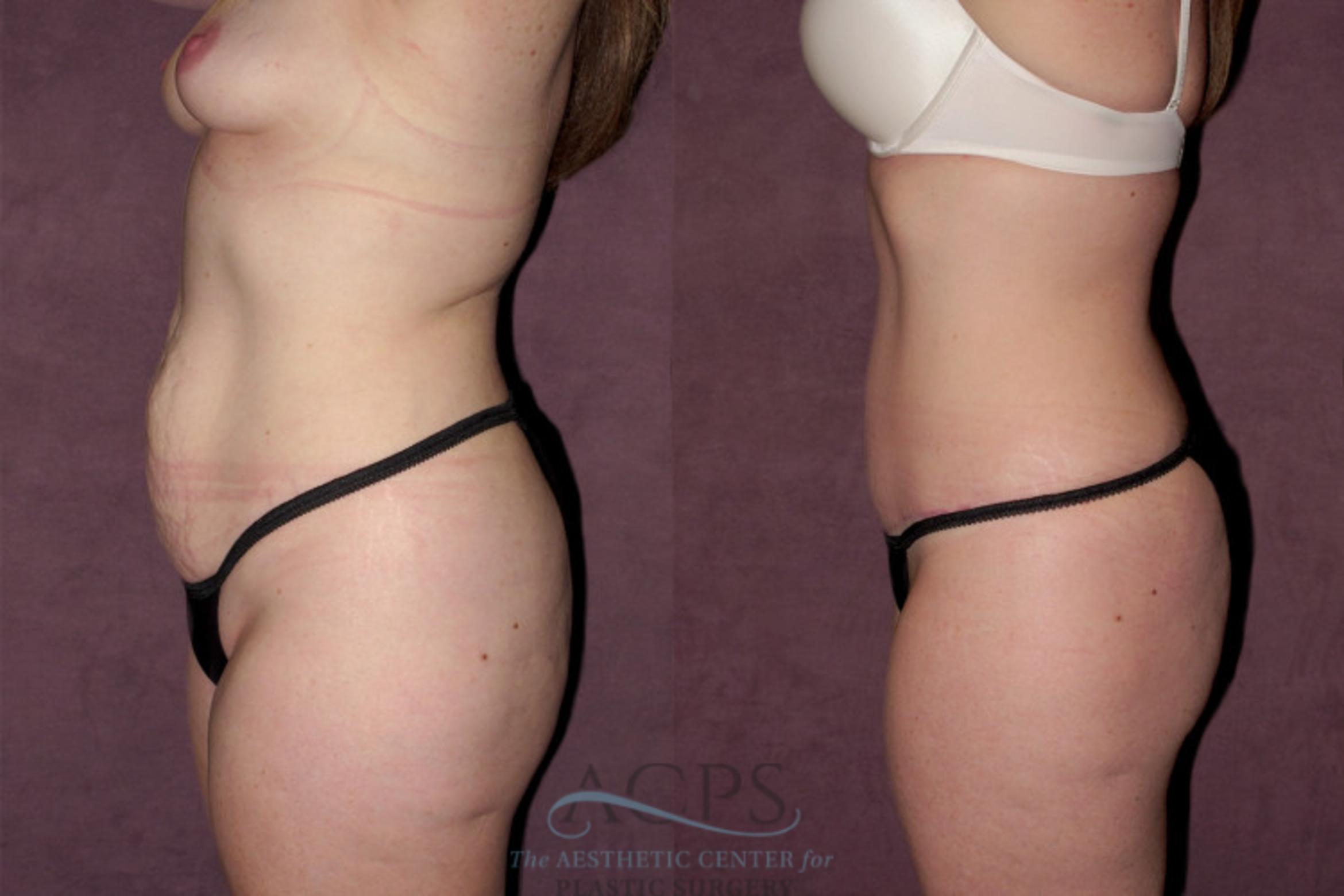 Before & After Tummy Tuck Case 161 Side Left View: View in Houston, TX