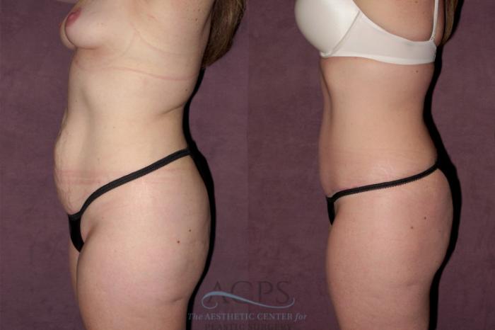 Before & After Tummy Tuck Case 161 Side Left View: View in Houston, TX