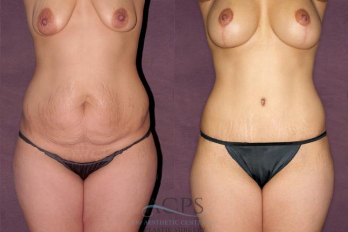 Before & After Tummy Tuck Case 162 Front View: View in Houston, TX
