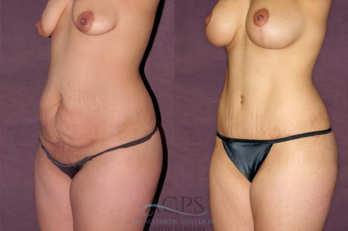 Before & After Tummy Tuck Case 162 Oblique Left View: View in Houston, TX