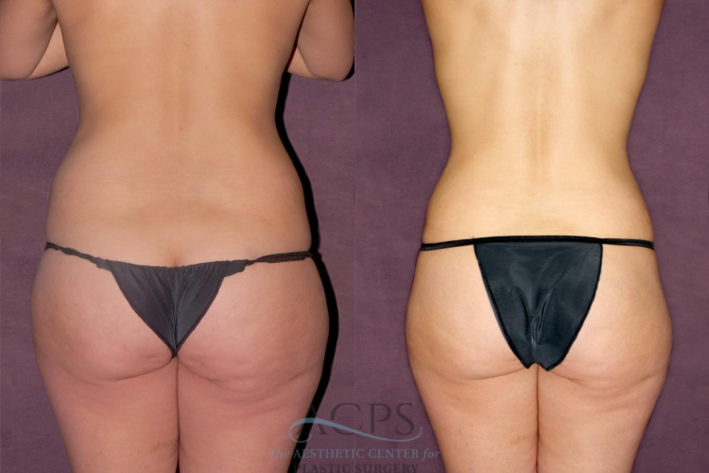 Before & After Tummy Tuck Case 162 Rear View: View in Houston, TX