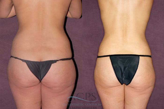 Before & After Tummy Tuck Case 162 Rear View: View in Houston, TX