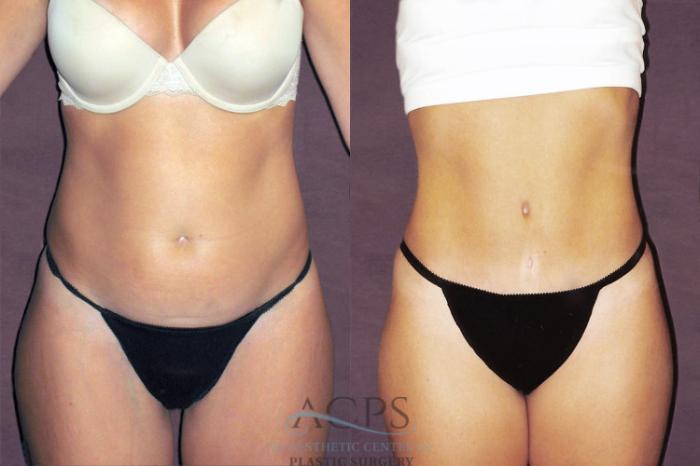 Before & After Tummy Tuck Case 163 Front View: View in Houston, TX