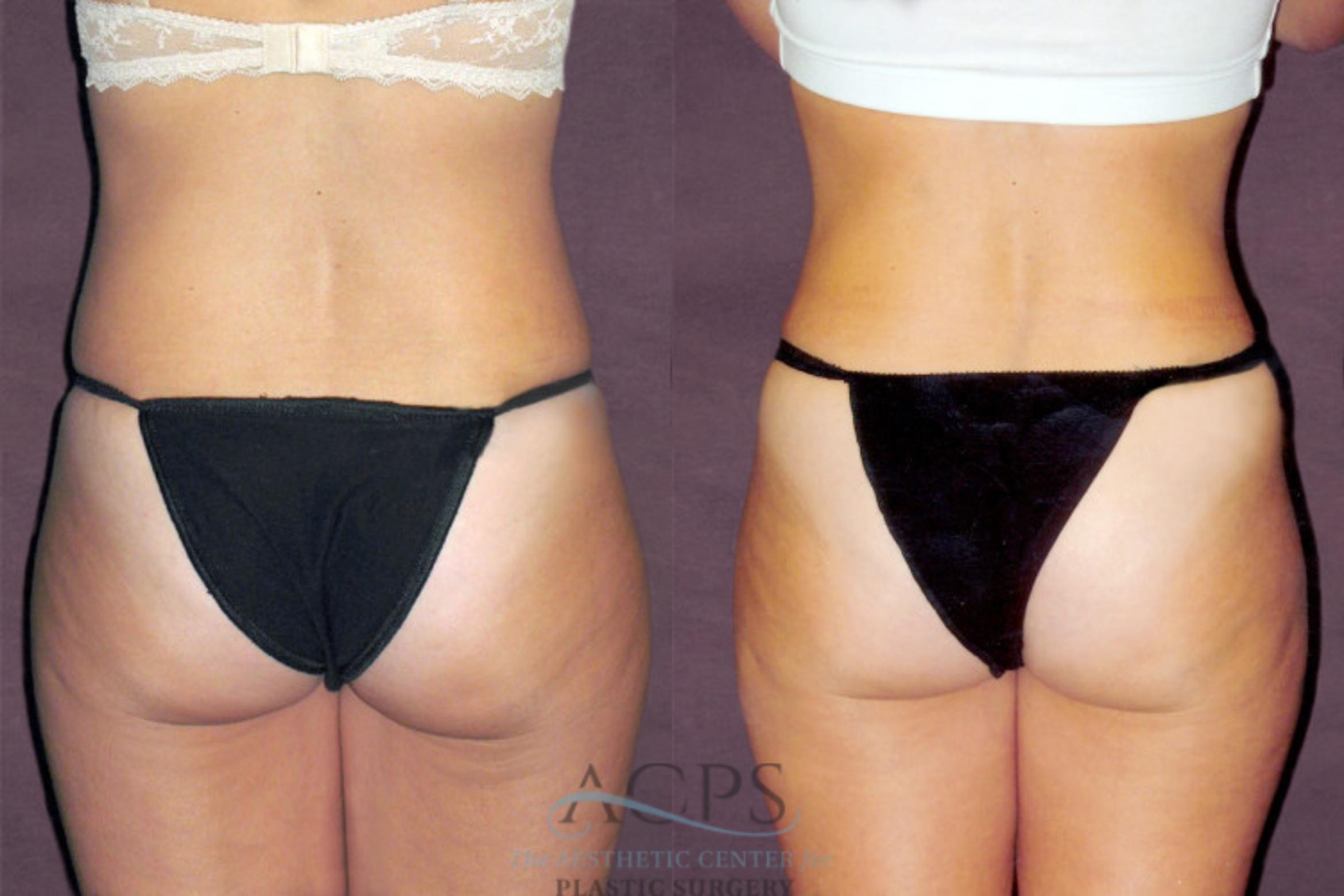 Before & After Tummy Tuck Case 163 Rear View: View in Houston, TX