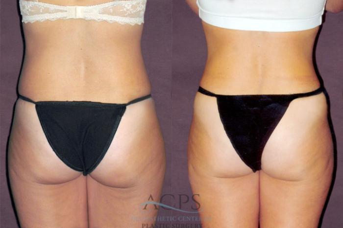 Before & After Tummy Tuck Case 163 Rear View: View in Houston, TX