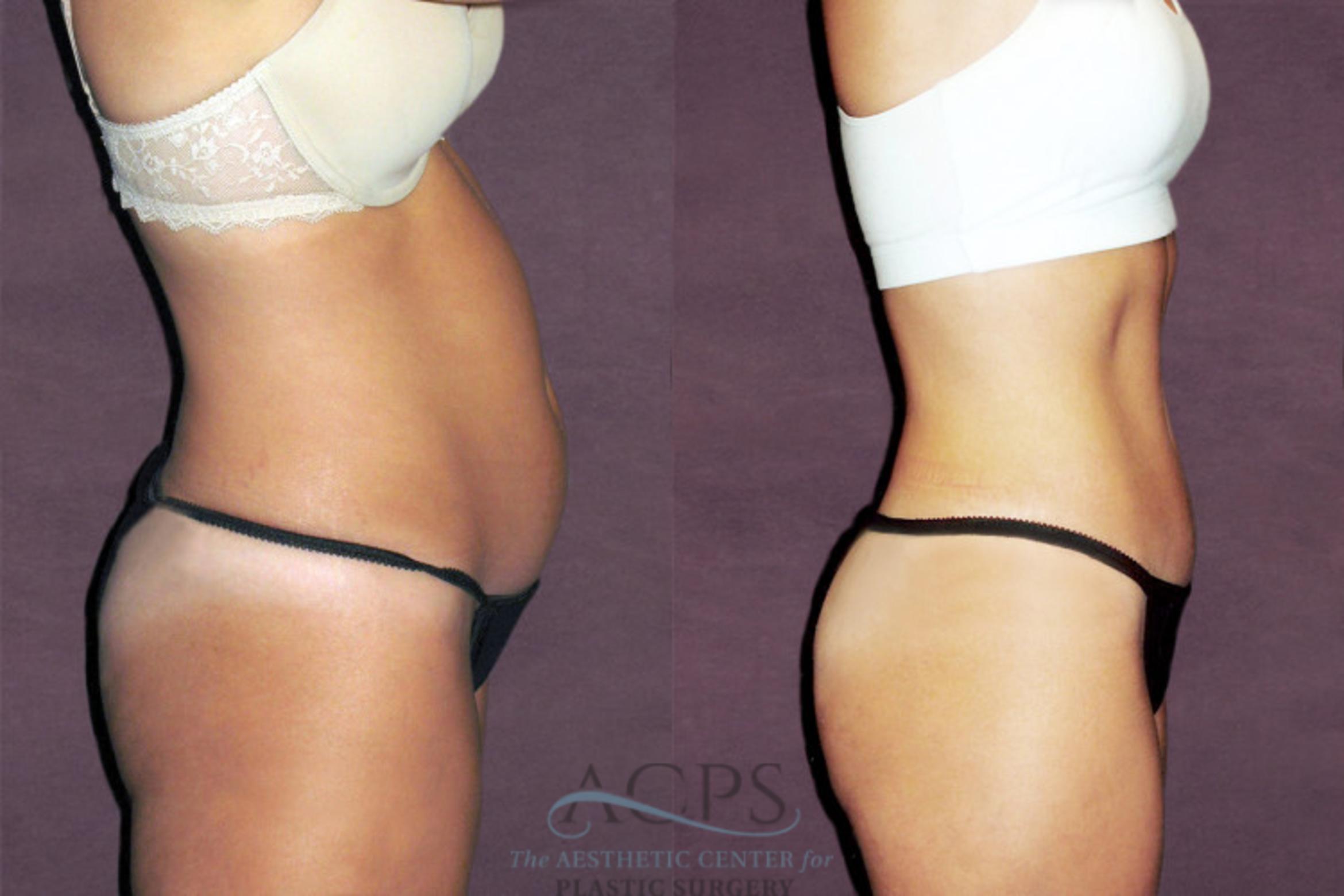 Before & After Tummy Tuck Case 163 Side Right View: View in Houston, TX